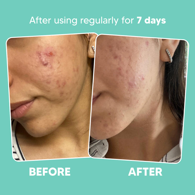 Ilana Clarifying Serum | Anti Acne Facial Oil | 15ml